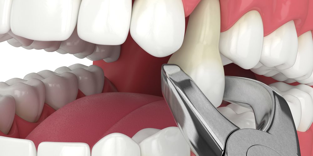 3d,Render,Of,Lower,Jaw,With,Tooth,Extracted,By,Dental tooth extractions near me