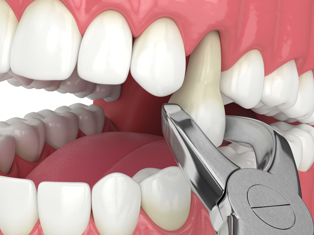 tooth extractions near me